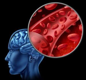 What Are the Chances of Surviving a Brain Bleed? | Bleeding of the