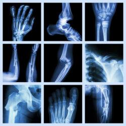 Can an Elderly Person Die from Bone Fractures? | Nursing Home Injury ...