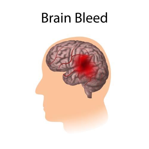 what-are-the-symptoms-of-a-slow-brain-bleed-bleeding-of-the-brain