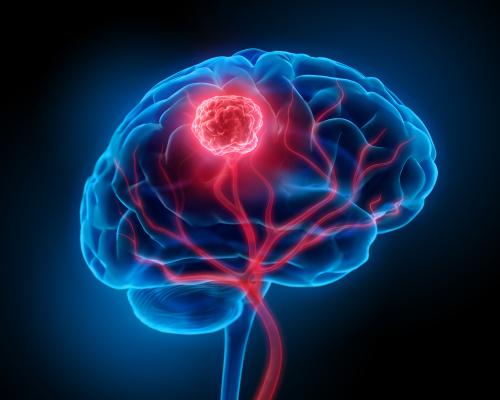 Brain Tumor | Bleeding of the Brain | My Nursing Home Lawyer